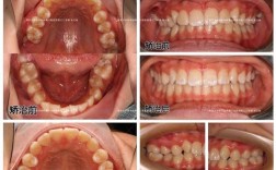 市一口腔科正畸效果如何？矫正周期多久？
