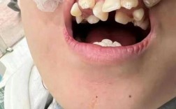 矫正牙齿过程中牙齿越来越歪，到底是什么原因导致的？