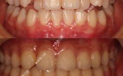 正畸中第一前磨牙为何常被优先考虑拔除？需权衡哪些因素？