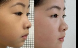 双颌前突正畸前后，脸型和咬合改善效果究竟如何？