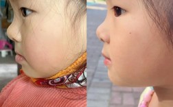 矫正地包天图片能真实展示矫正效果吗？