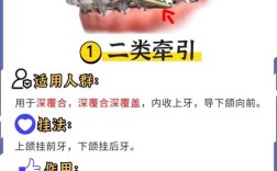 为什么要带口外正畸牵引