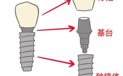 种牙选牙齿，材质、品牌、效果怎么选？