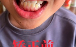 地包天矫正牙齿过程具体是怎样的？详细步骤有哪些？