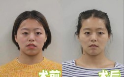 叶翁三杰正畸失败案例