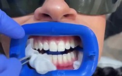 杭州冷光美白牙齿方法