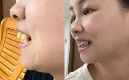 拔牙正畸前后脸型变化图