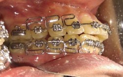 正畸弓丝往一边跑