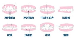 错合畸形分类方法的主要类型有哪些？
