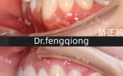 正畸个别牙高位错位是什么原因，如何处理？