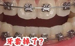 正畸弹簧断了怎么办