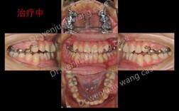 宁波矫正牙齿怎么选？哪家好又划算？