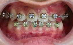 矫正牙齿后上下无法咬合，是什么原因导致的？