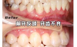 矫正牙齿不拔牙效果图