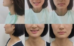 正颌正畸前后对比，脸型和咬合变化究竟有多显著？