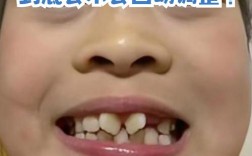 小孩牙齿长歪怎么矫正？不同年龄段矫正方法有哪些？