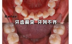 口腔正畸如何有效矫正牙列不齐？