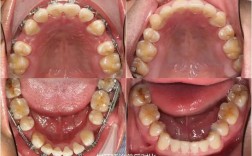 正畸减数拔牙是什么意思