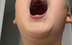 正畸扩弓过度会有哪些不良影响？