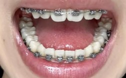 重医附一院牙齿矫正效果如何？适合哪些人做？