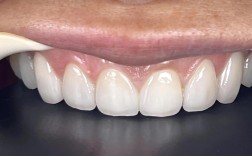 瓷贴面能做正畸