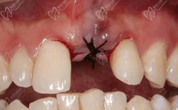 种牙拆线后牙疼，是什么原因？是否正常？