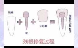 种一个桩安两颗牙可行吗？一个种植体如何支撑两颗牙齿，这种修复方式的安全性与适用条件是什么？