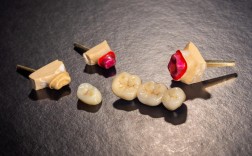 种牙什么材质的好