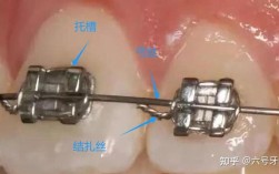 正畸托槽是拿来掰的吗？矫正时能手动调整吗？