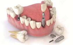 种牙修复体究竟是什么？它的作用与优势有哪些？