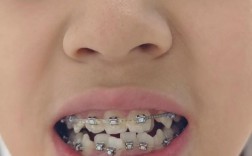 正畸上牙14下牙12，为何上下牙数不同？矫正方案如何调整？