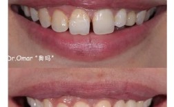 做过美容冠后还能进行正畸矫正吗？正畸过程中会影响美容冠效果或需要提前拆除吗？