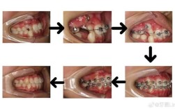 正畸尖牙回扎方法