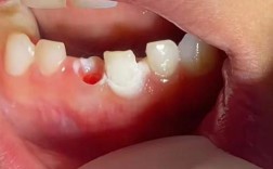 牙齿脱落一年后，还能种牙吗？