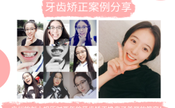 广州牙齿矫正哪家医院好？求靠谱推荐