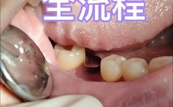 种植体取出有哪些具体方法？不同骨结合状态和种植年限下如何选择术式？