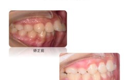 正畸牙齿 移动速度