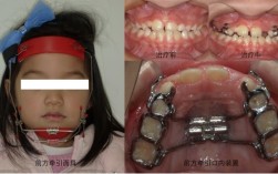 口腔残根正畸牵引视频如何牵引？