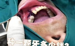 苏州医保能用于种牙吗？报销比例及政策如何？