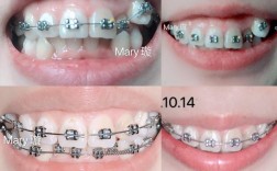 正畸牙缝收得慢，是什么原因导致的？