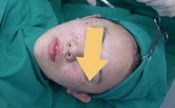 正畸骨皮质切开术的操作步骤、技术要点及临床应用注意事项有哪些？