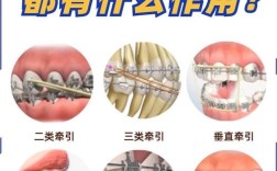 正畸里牵引是什么原因