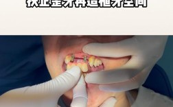 种植牙 邻牙 倾斜