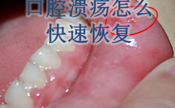 口腔有溃疡可以植牙吗