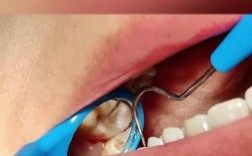 牙周纤维袋使用方法