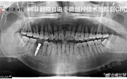 种牙没有愈合帽？会有什么影响吗？
