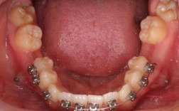 正畸拔牙上4 下5