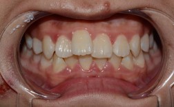 青少年正畸为何会出现后遗症？如何避免？