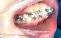 牙齿正畸自锁好还是普通