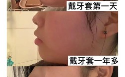 牙齿正畸前后脸型变化图片靠谱吗？正畸医生揭秘面部轮廓改善的真实原理与注意事项